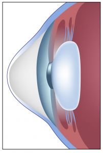 Keratoconus Treatments York PA - Keratoconus Specialist of Maryland