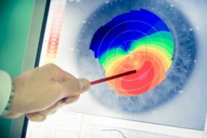 Keratoconus_Treatments-baltimore