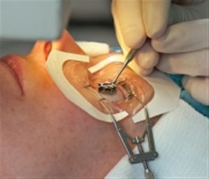 cornea-transplant-for-keratoconus