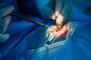 keratoconus-corneal-transplant