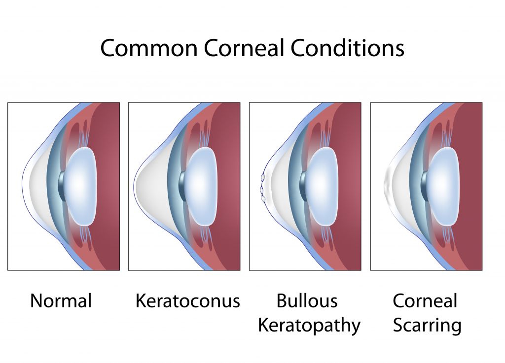 keratoconus doctor baltimore