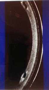 scleral-keratoconus-contact-lenses-